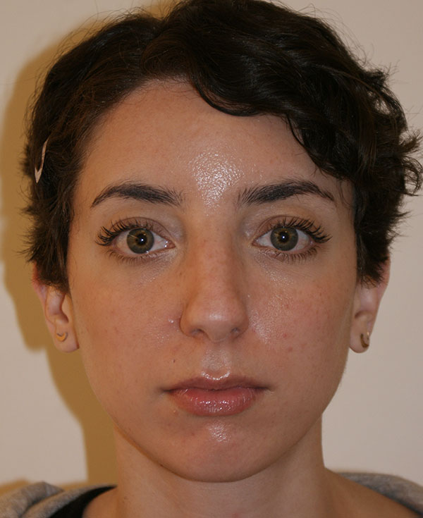 Chin Implants before and after - before