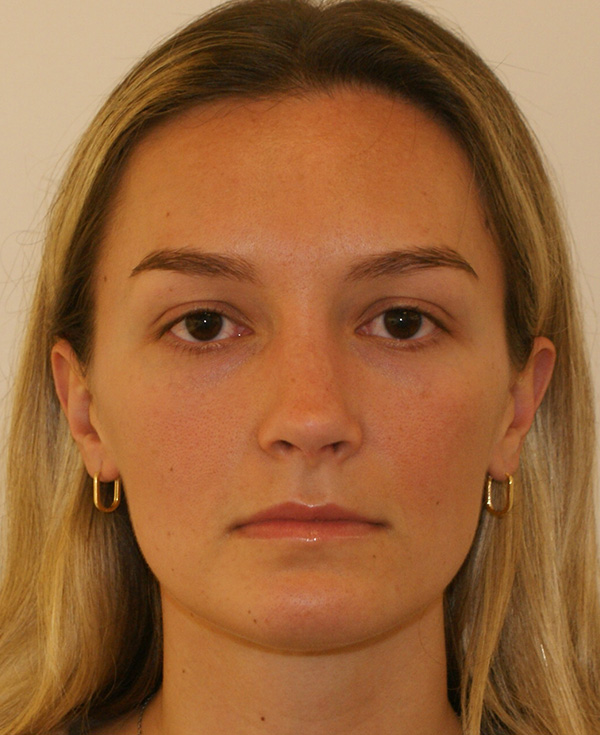 Rhinoplasty before and after - after