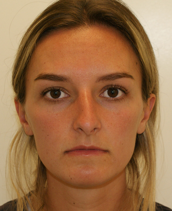 Rhinoplasty before and after - before