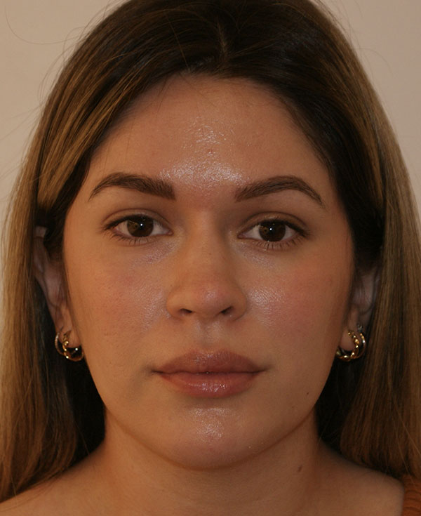 Rhinoplasty before and after - after