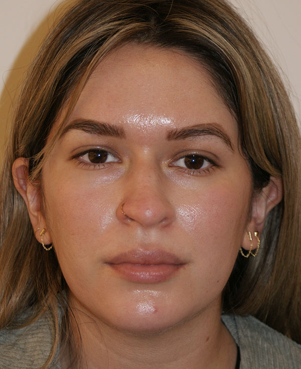 Rhinoplasty before and after - before