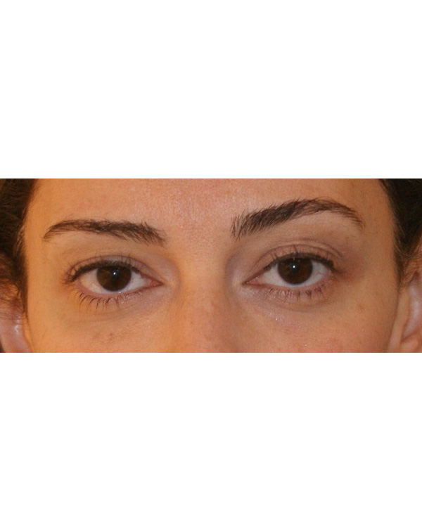 Facial Fat Transfer before and after - after