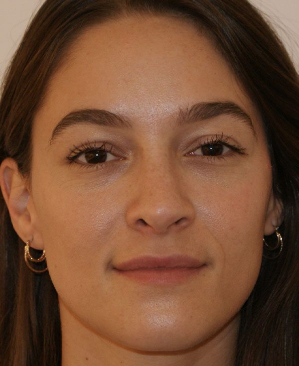Rhinoplasty before and after - after