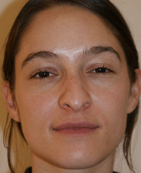 Rhinoplasty before and after - before