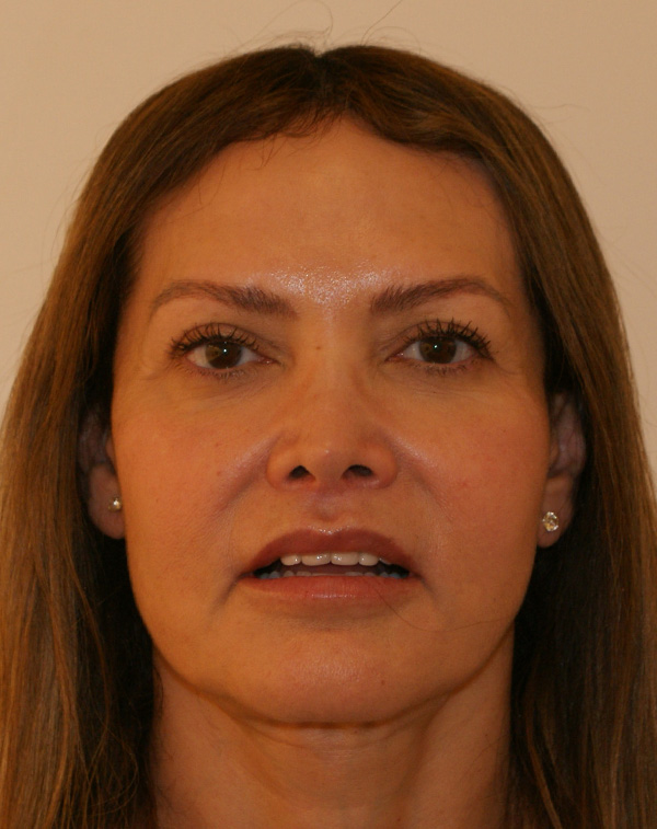 Lip Lift before and after - after