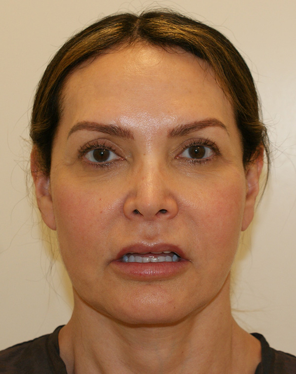 Lip Lift before and after - before