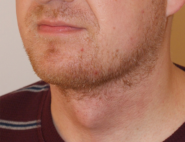 Short Scar Neck Lift before and after - after