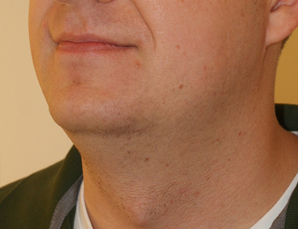 Short Scar Neck Lift before and after - before