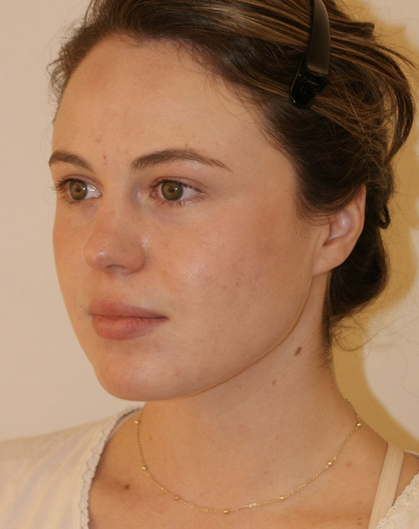 Short Scar Neck Lift before and after - after