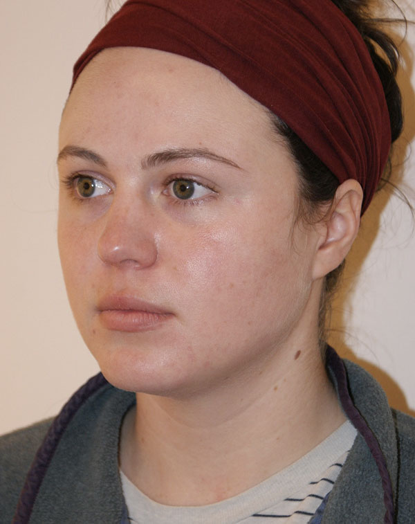 Short Scar Neck Lift before and after - before