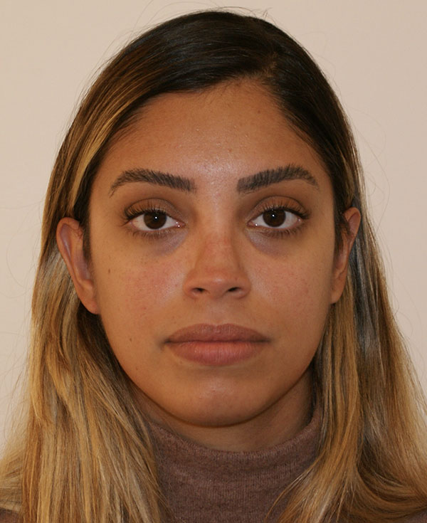 Chin Implants before and after - after
