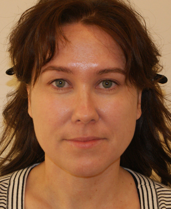 Rhinoplasty before and after - after