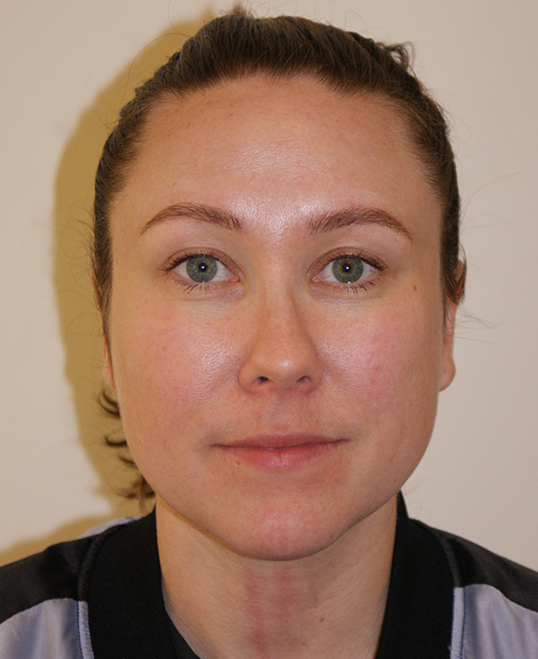 Rhinoplasty before and after - before