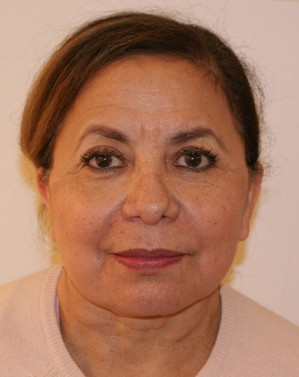 Face and Neck Lift before and after - after