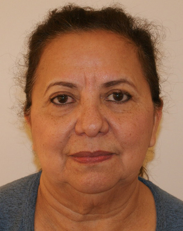 Face and Neck Lift before and after - before