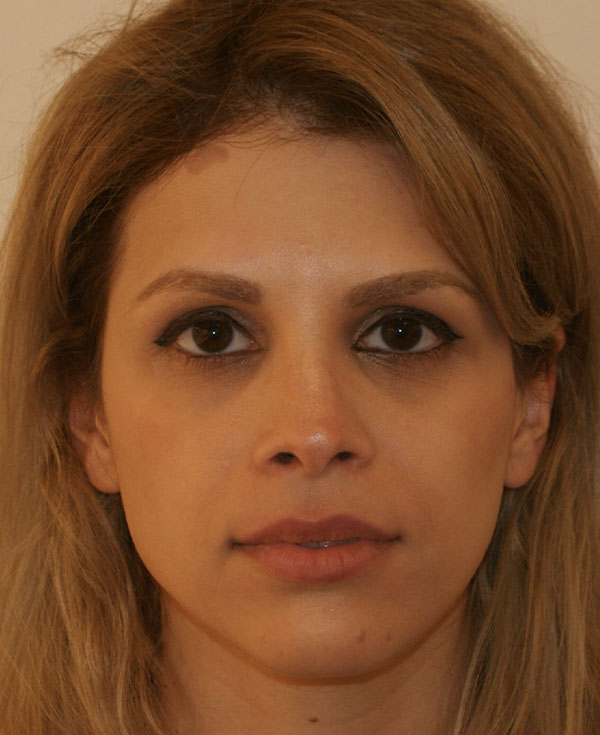 Rhinoplasty before and after - after