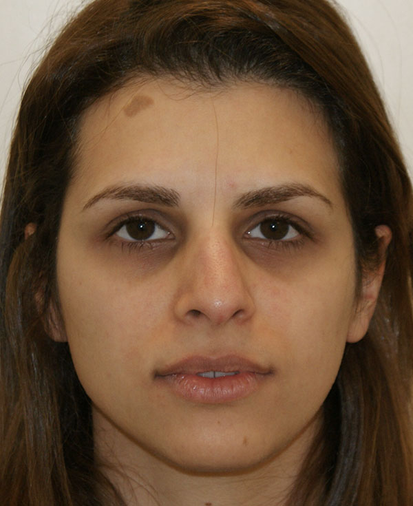 Rhinoplasty before and after - before