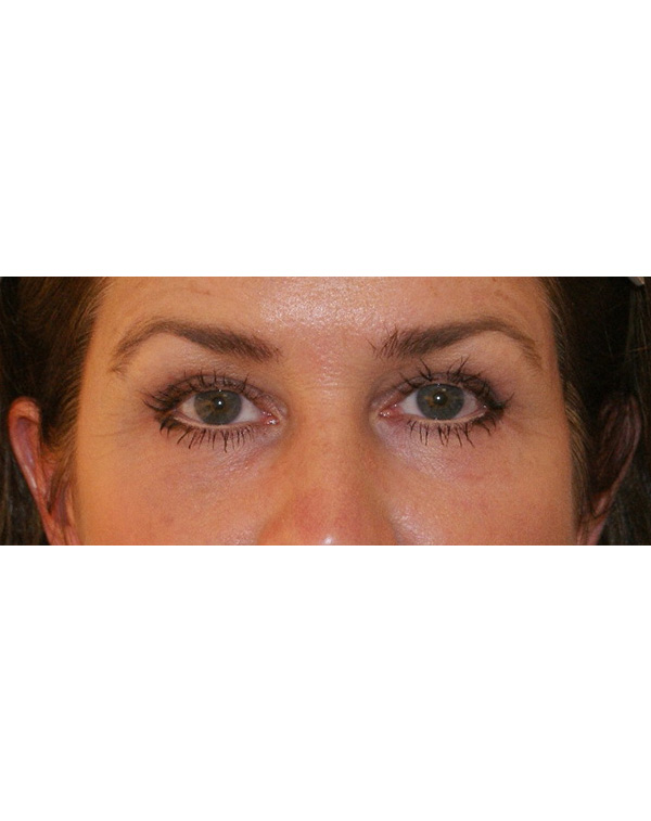 Facial Fat Transfer before and after - after