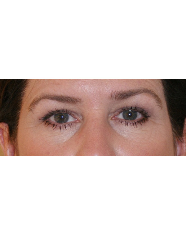 Facial Fat Transfer before and after - before