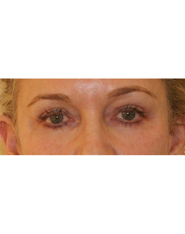 Facial Fat Transfer before and after - after