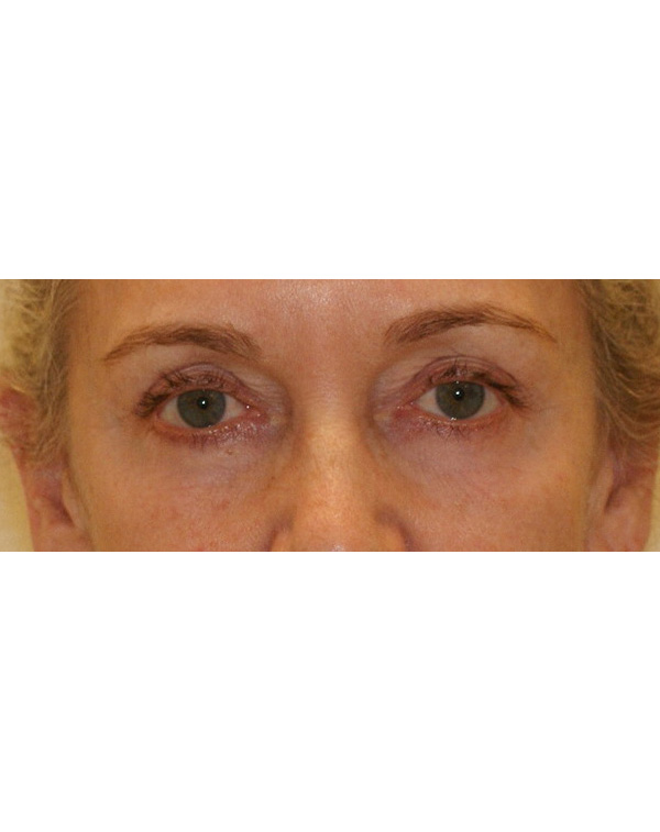 Facial Fat Transfer before and after - before