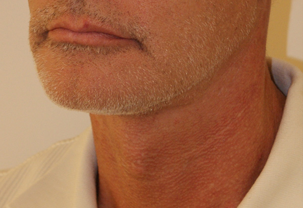 Face and Neck Lift before and after - after