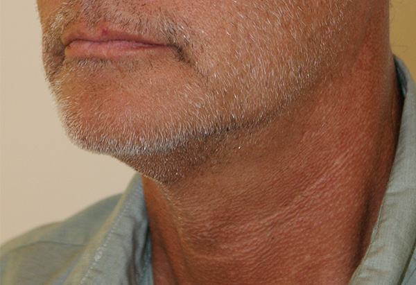 Face and Neck Lift before and after - before