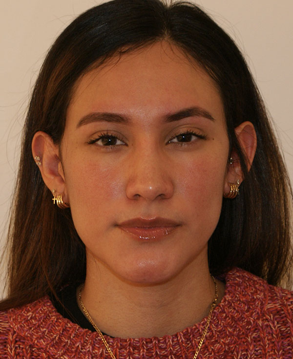 Rhinoplasty before and after - after