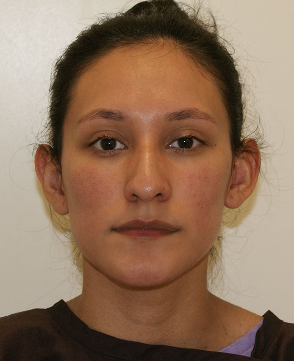 Rhinoplasty before and after - before