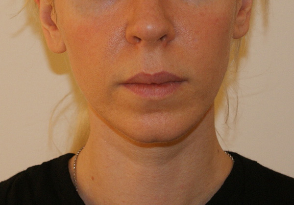 Chin Implants before and after - after