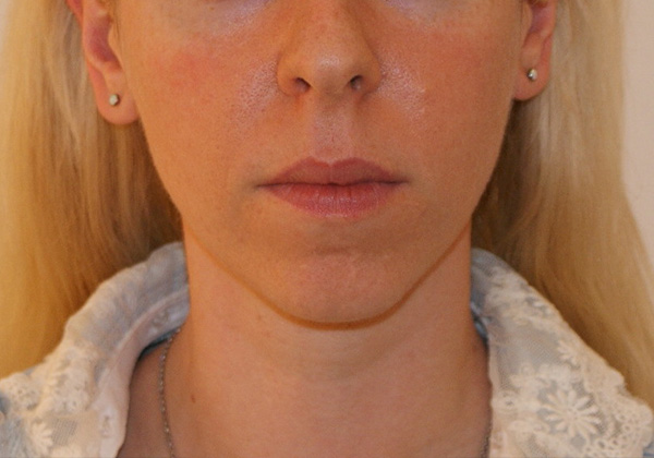 Chin Implants before and after - before
