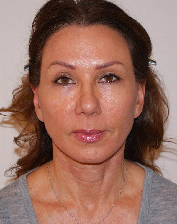Face and Neck Lift before and after - after