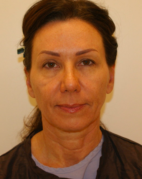 Face and Neck Lift before and after - before