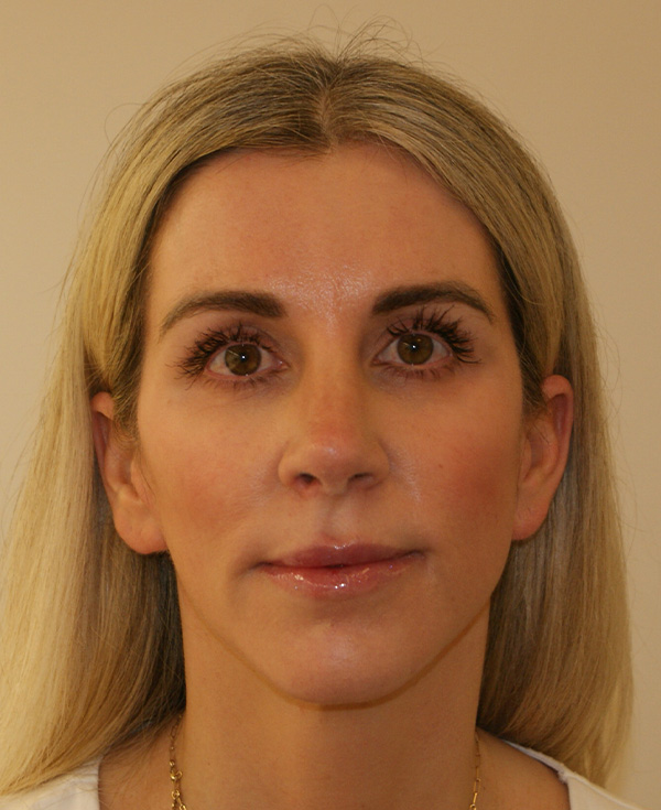 Rhinoplasty before and after - after