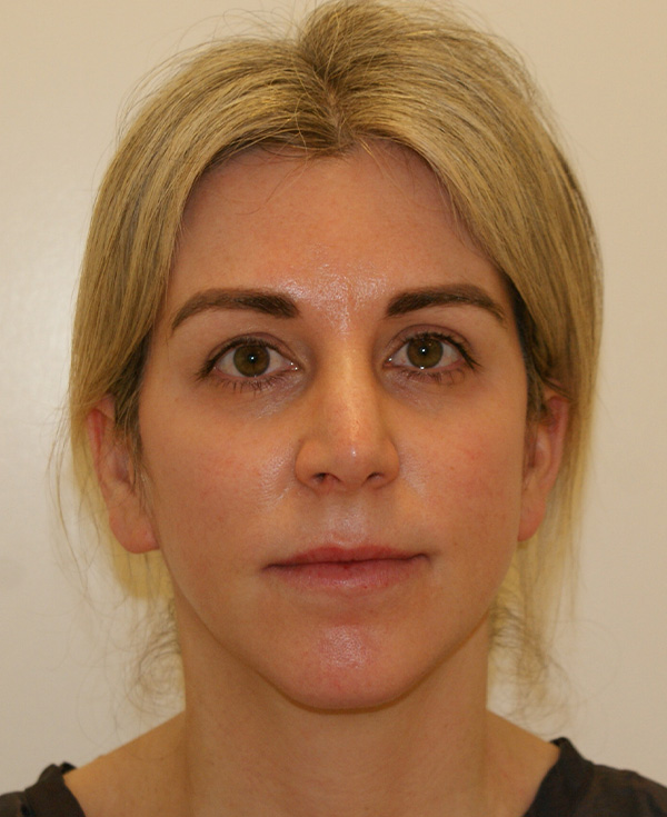 Rhinoplasty before and after - before