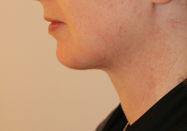 Chin Implants before and after - after