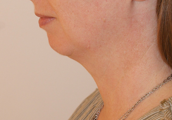 Chin Implants before and after - before