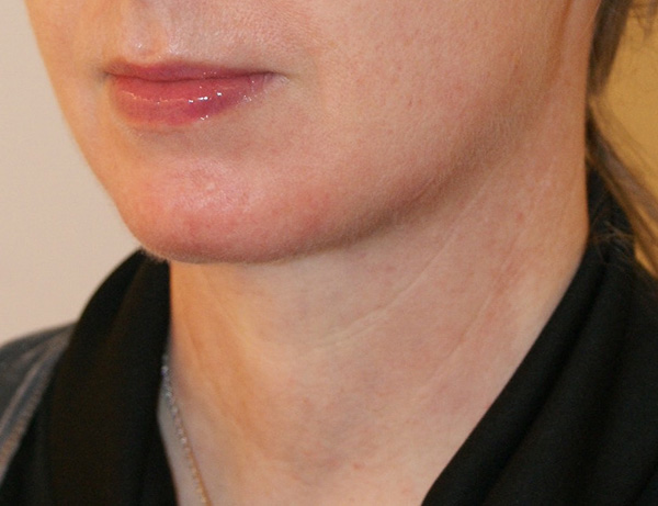 Short Scar Neck Lift before and after - after
