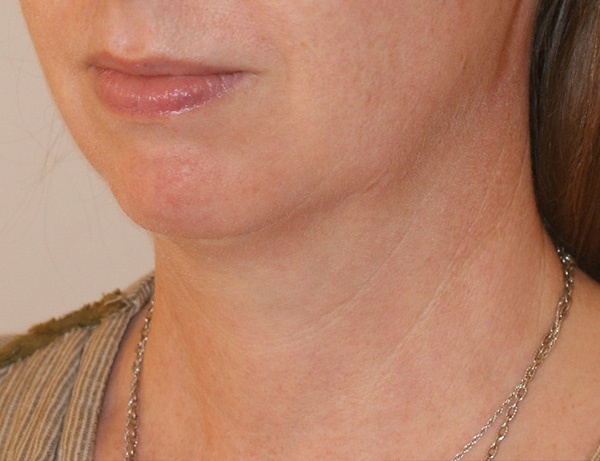 Short Scar Neck Lift before and after - before