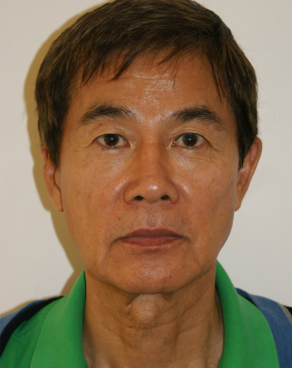 Face and Neck Lift before and after - before