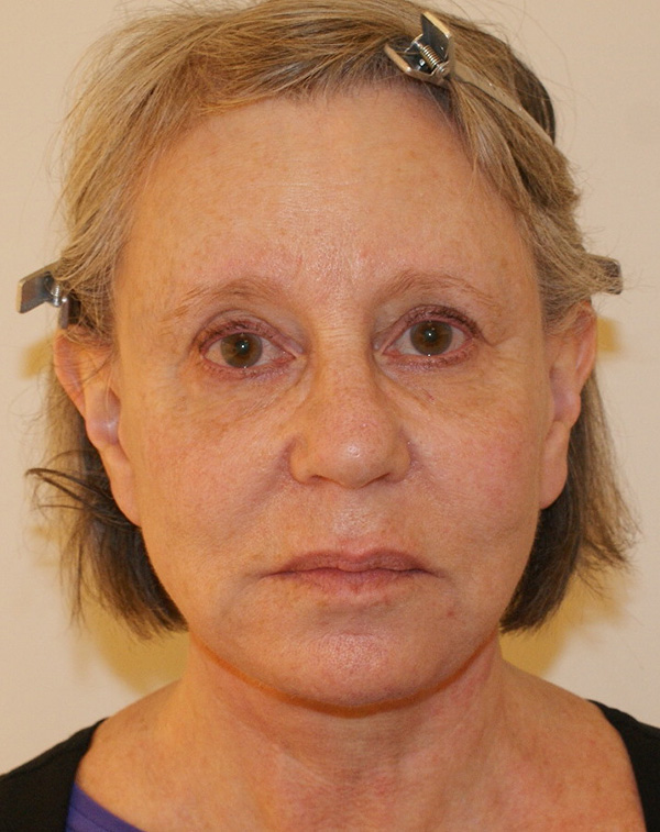 Face and Neck Lift before and after - after