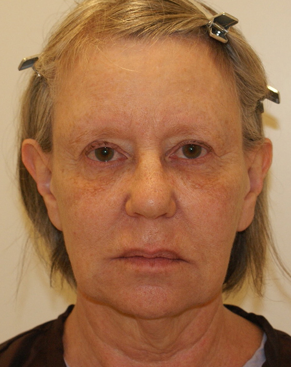 Face and Neck Lift before and after - before