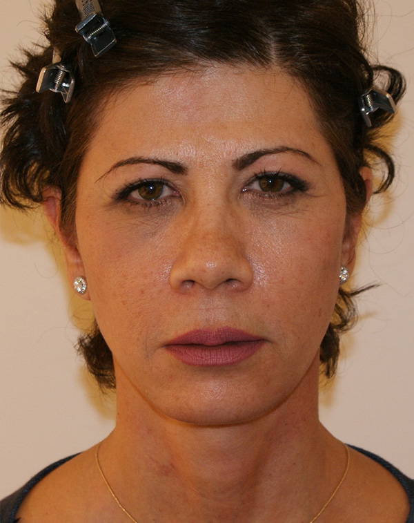 Facial Fat Transfer before and after - after