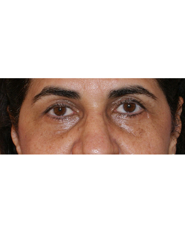 Facial Fat Transfer before and after - after