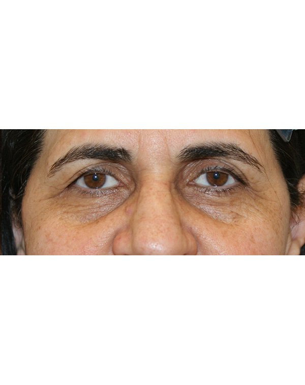 Facial Fat Transfer before and after - before