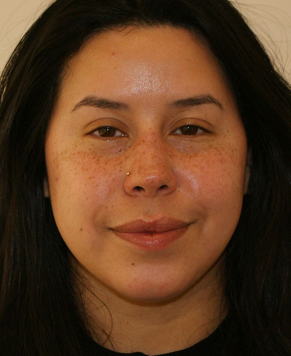 Rhinoplasty before and after - after