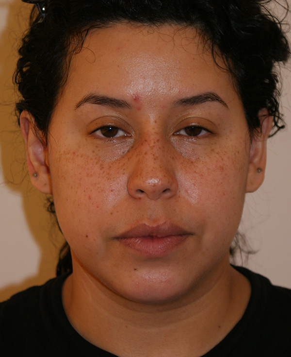 Rhinoplasty before and after - before