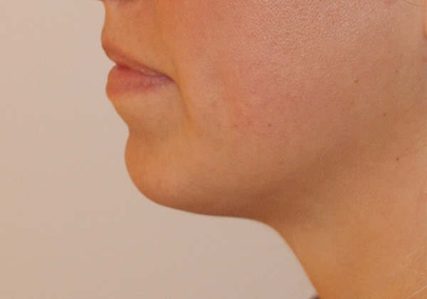 Chin Implants before and after - after