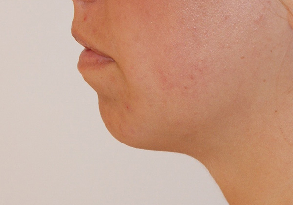 Chin Implants before and after - before