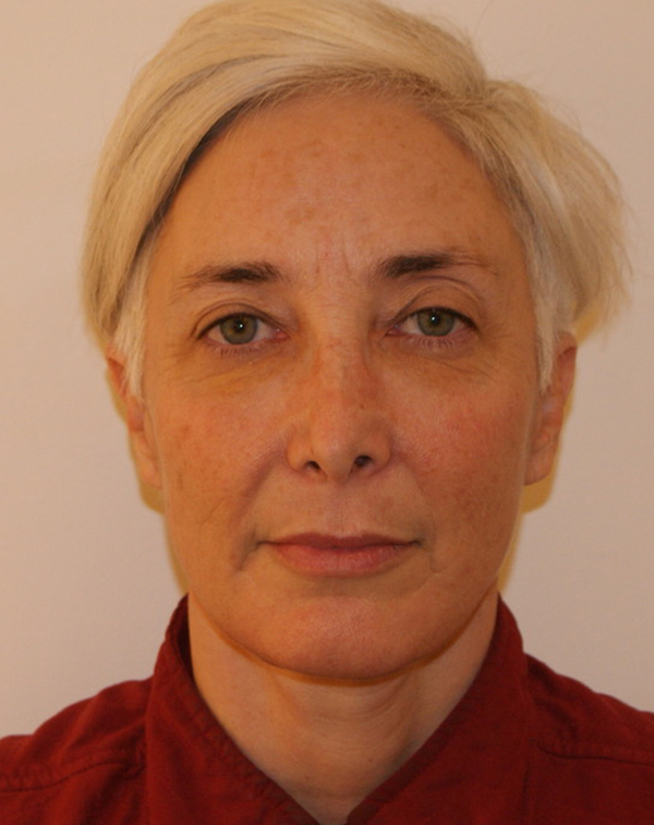 Face and Neck Lift before and after - after